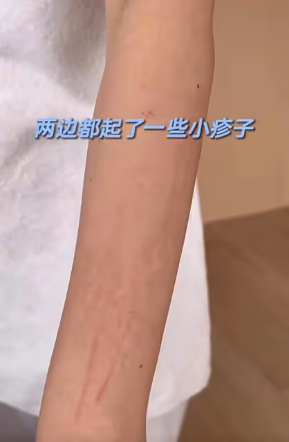 王石愛妻田朴珺裹浴巾出鏡,肩膀兩大處紅腫傷痕,素顏模樣變化大