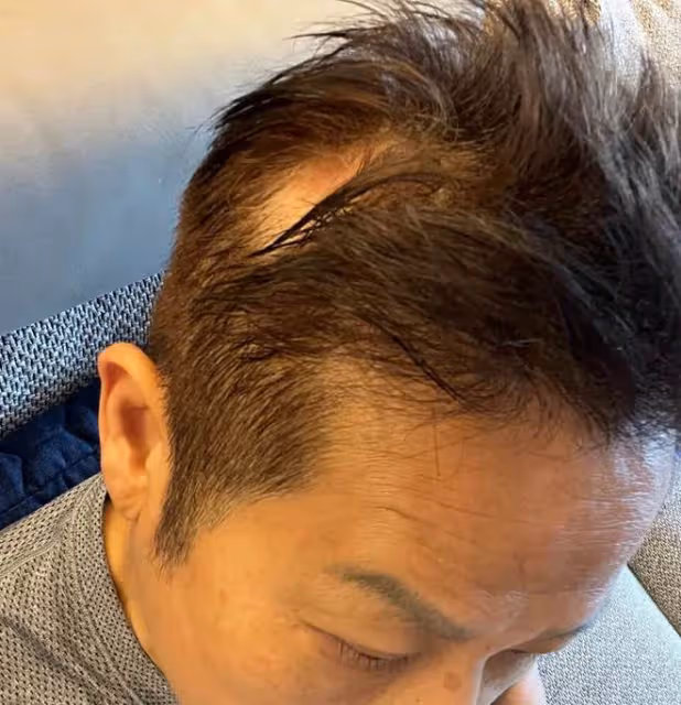 知名男星在美國突發疾病!傷口化膿頭部禿一塊,上月卷性騷擾風波
