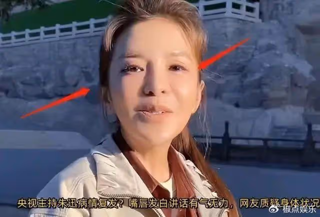 朱迅被疑整容失敗大變樣!嘴歪臉僵撞臉宋小寶,健康狀況令人擔憂