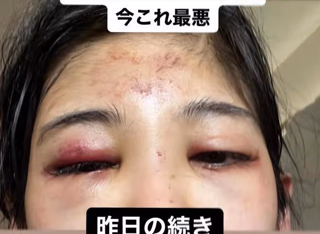 30歲大胃王因厭食症離世,搶救治療3個月,最後暴瘦模樣曝光