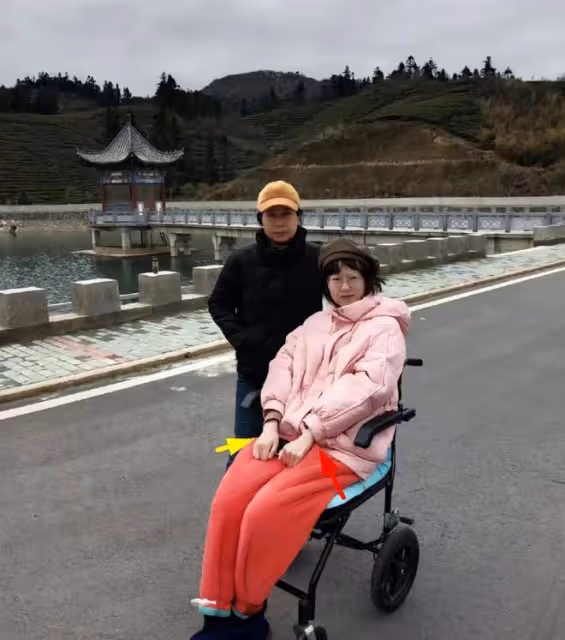 24歲抗癌網紅去世！骨癌4年放療31次，生前暴瘦至70斤瘦到變形