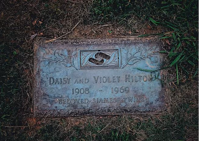 回顧希爾頓姐妹,貌美卻臀部相連,姐姐死後,妹妹與遺體共存2天