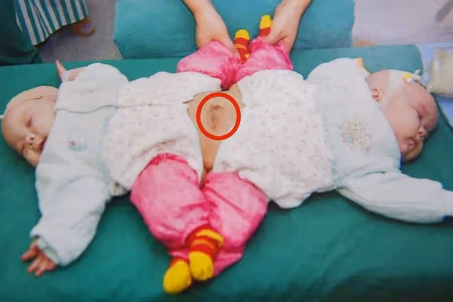 09年,湖北降生一對坐骨連體女嬰,手術15小時分離成活,後來如何