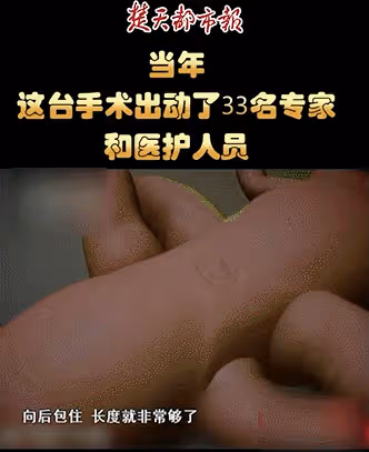 09年,湖北降生一對坐骨連體女嬰,手術15小時分離成活,後來如何