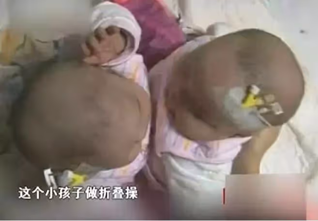 09年,湖北降生一對坐骨連體女嬰,手術15小時分離成活,後來如何