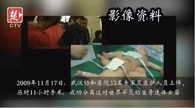 09年，湖北降生一對坐骨連體女嬰，手術15小時分離成活，後來如何