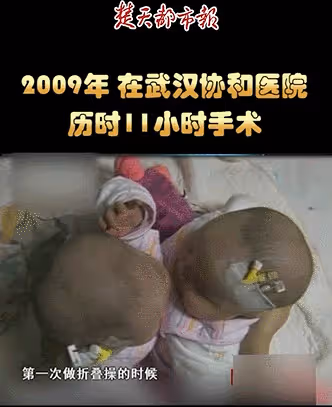 09年，湖北降生一對坐骨連體女嬰，手術15小時分離成活，後來如何