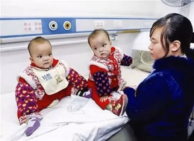 09年，湖北降生一對坐骨連體女嬰，手術15小時分離成活，後來如何
