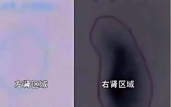 陝西女子體檢發現左腎丟失,意外牽出8年前手術疑雲,獲賠26萬