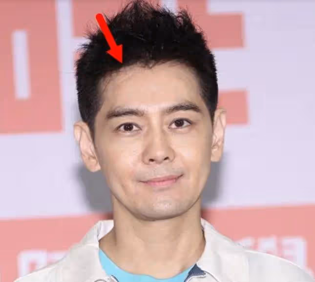 林志穎車禍後首露面部傷疤,稱視力理解能力變差,身體還沒恢復