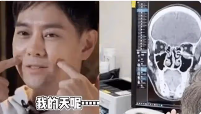 林志穎車禍後首露面部傷疤,稱視力理解能力變差,身體還沒恢復