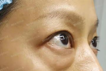 40~60歲值得做的醫美項目:外切眼袋手術