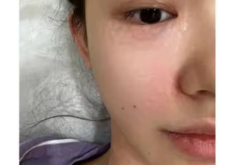 27歲林允公開醫美過程,為去皺紋臉上扎滿針眼,直呼醫美需謹慎