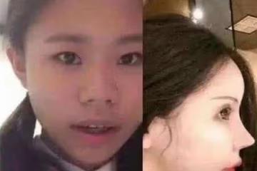 女孩為了變美,花100萬瘋狂整容,揚言母親支持,前後對比如換臉