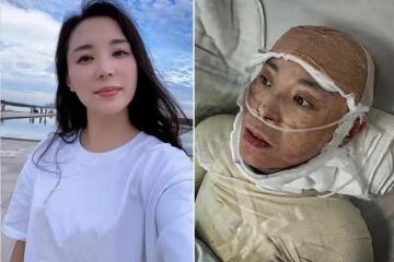 美媽凌晨拔火罐欲解酸痛,不料發生悲劇,從此全身戴上「緊箍咒」