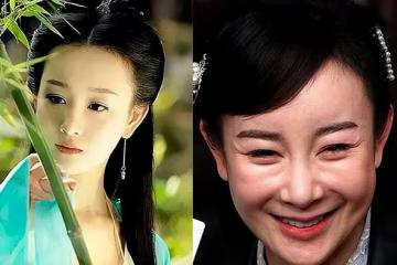 取出假體，她的臉又美回來啦！