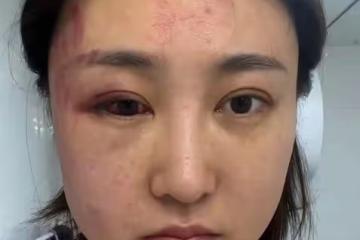 34歲女星慘遭家暴！深夜被拖拽進房間打到眼睛出血，絕望發聲求助
