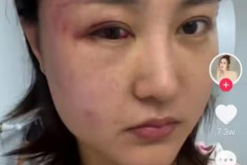 34歲女演員被家暴,拖進房間打到眼腫充血,絕望發聲只為離婚