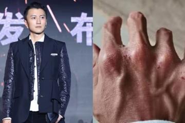 謝霆鋒拍戲受傷　手嚴重變形、關節明顯突出