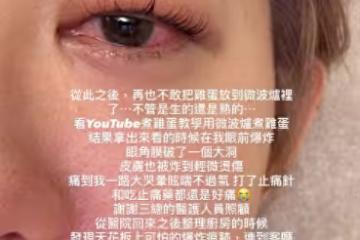 王晴微波雞蛋炸傷眼「流理台也炸碎」！　難忍角膜破裂疼痛：快昏去