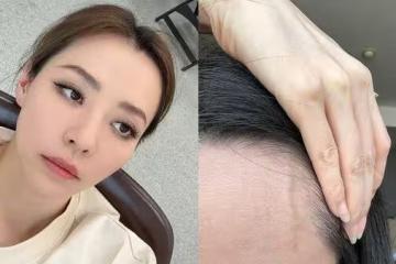 張靚穎健康亮紅燈!伸懶腰就滲血 額頭詭異突一條「查不出原因」