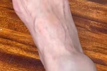 六月腳踝翻船「要撐拐杖一陣子」 苦笑:跑得兇猛跌得厲害