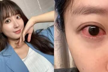 洪詩坐月子驚傳「角膜糜爛」! 眼睛劇紅近況曝光:真的要聽話