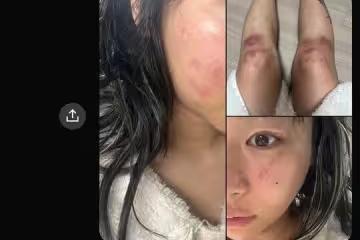 全身傷痕累累!韓女星控前男友軟禁掐頸 淚訴:公開才能結束
