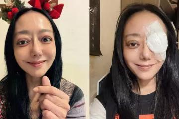 高慧君暴瘦24kg！在家昏倒臉骨折…整顆頭腫脹「1部位」永遠消失