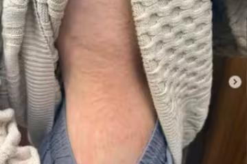 許允樂掀衣「側腰大面積發腫」!突發蕁麻疹1個月⋯過敏原出爐崩潰了