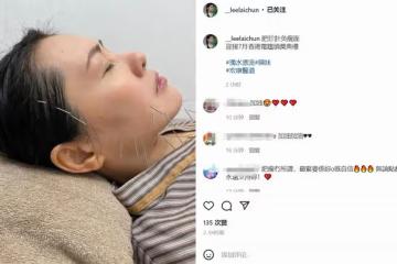 56歲李麗珍曬針灸瘦臉照，自嘲是肥珍！失戀後患抑鬱症一度暴肥