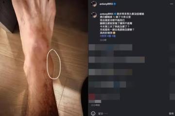 郭彥均騎完腳踏車「腳踝突腫到不能彎」！過3天還沒好：到底怎麼了