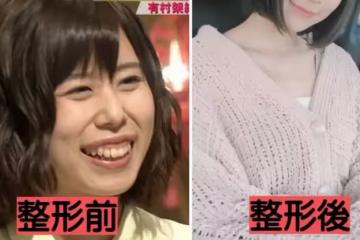 自卑到不敢笑!暴牙凸嘴女星「被酸長得像蟑螂」 砸100萬整形變「甜美大眼正妹」網驚:笑容好美