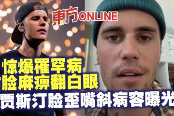 驚爆罹罕病右臉麻痹翻白眼 小賈斯汀臉歪嘴斜病容曝光