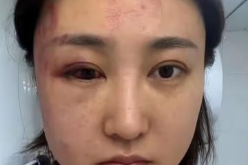 34歲女星遭家暴後現身派出所！打到眼出血被鑑定輕傷，老公已拘留