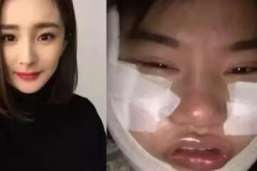 女大生「砸450萬整型」為了變楊冪， 紗布拆下後，網友驚：比楊冪還還美