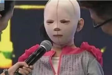 10歲女孩整天帶著「頭套」,同學都嘲笑她是「怪物」,摘下面具後眾人淚奔!