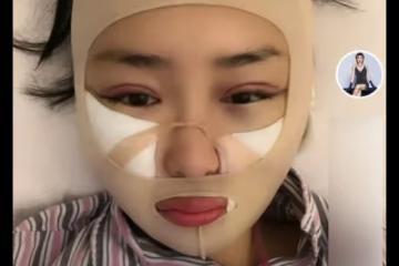本山傳媒嬌嬌自曝整容,曬術後照被指認不出,多次割眼皮腫脹明顯