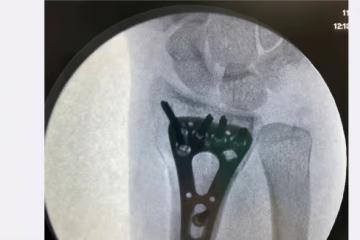 謝楠橈骨粉碎性骨折後續,手術成功後吳京神回應,鐵憨憨上線