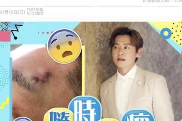 TVB演員張振朗拍戲出意外，眉骨被燈撞傷破相，送醫縫7針恐留傷疤